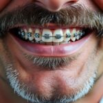 découvrez comment fonctionne l'appareil dentaire moustache, nos conseils pour bien le porter et sa durée d'utilisation pour un sourire parfait.